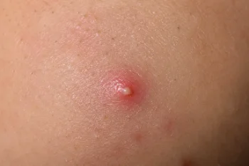 Inflammatory Acne Vulgaris Close-Up