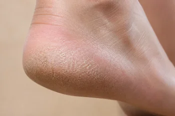 Cracked Heel (Heel Fissures) Close-Up Clinical Photograph