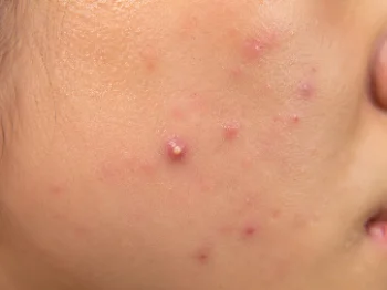 Acne on cheek and jawline medical skin condition portrait
