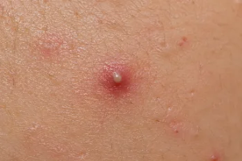 Inflammatory Acne Vulgaris Close-Up