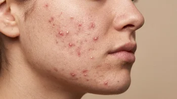 Acne on cheek and jawline medical skin condition portrait
