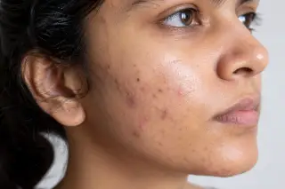 acne on face 
