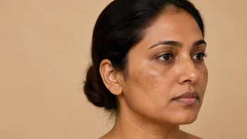 Facial Hyperpigmentation and Melasma on Woman Cheek