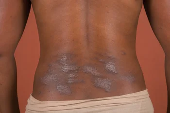 Psoriasis Plaques on Lower Back
