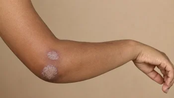 Psoriasis Plaques on the Elbow