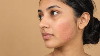 Close-up of Woman with Facial Skin Redness and Scaling