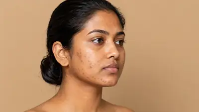 Young woman with facial skin blemishes and hyperpigmentation