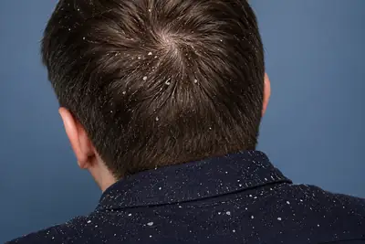 Severe Dandruff on Scalp and Shoulders of a Person
