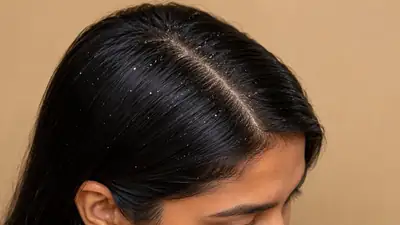 Close-up of human scalp showing dandruff and flaking hair