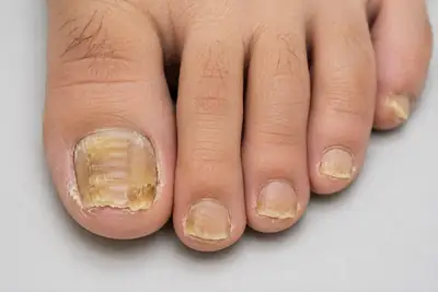 Severe Onychomycosis and Nail Dystrophy on Human Toes