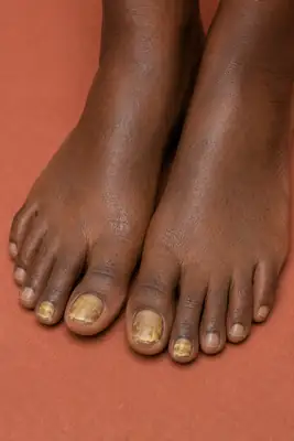 Toenail fungus infection on both feet
