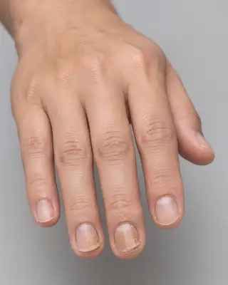 Fungal Infection on Fingernails Showing Discoloration and Brittleness