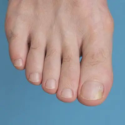 Nail changes on great toenail showing yellowish discoloration