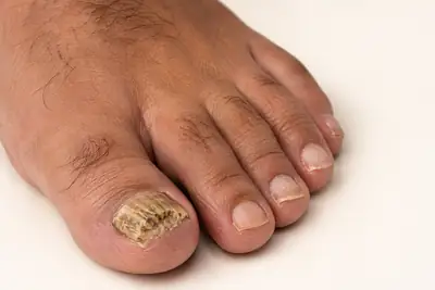 Severe Onychomycosis of the Great Toenail