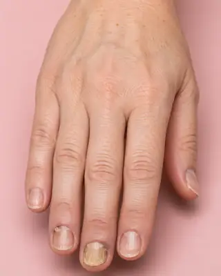Dermatological View of Fungal Nail Infection on Human Fingers