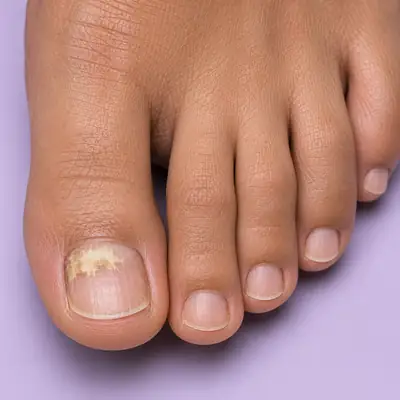 Close-up of toenail fungus on big toe