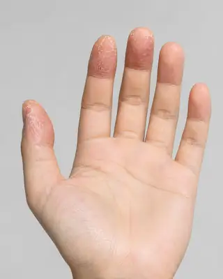 Severe peeling and scaling skin on human fingertips and thumb