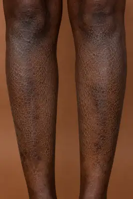 Severe Xerosis and Scaling on Dark Skin Legs