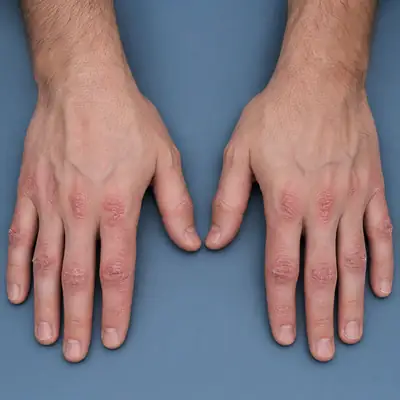 Dermatological Manifestation on Hands with Scaling and Erythema