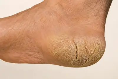 Severe Cracked Heels and Dry Skin