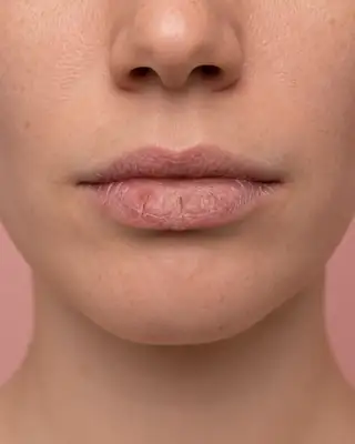 Close-up of Dry and Chapped Lips on a Woman's Face