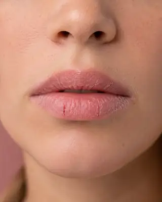 Close-up of Dry Chapped Lips with Fissures