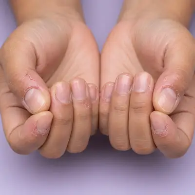 Severe Dry Skin and Cracking Around Fingernails and Cuticles