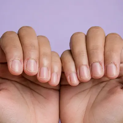 Dry Cuticles and Paronychia Symptoms on Fingers