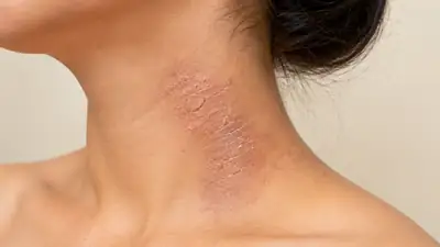 Eczema Rash and Dry Skin on Neck