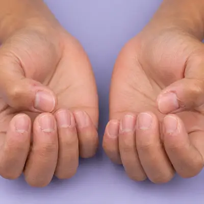 Hands with Dry Skin and Cuticle Damage