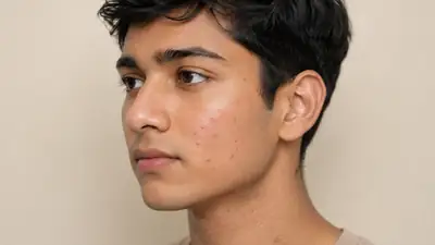 Young Man with Facial Acne