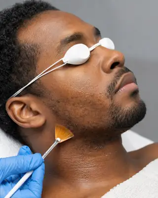 Male Patient Receiving Chemical Peel Treatment - Dermatology Stock Photo