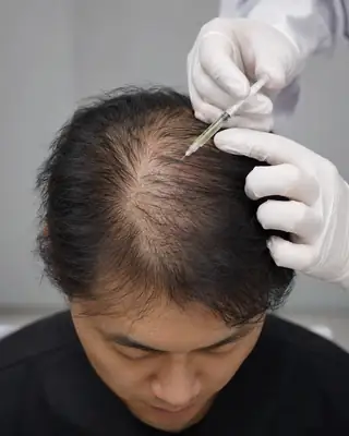 Patient Receiving Crown PRP Therapy for Hair Loss Treatment