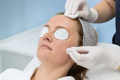 Female Patient Undergoing Jessner Peel Treatment in Dermatology Clinic