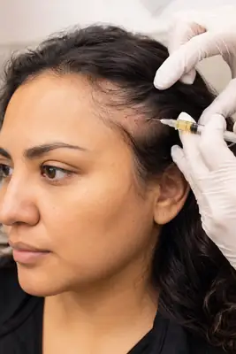 PRP Hair Loss Therapy Injection on Patient Temple Clinical Photo
