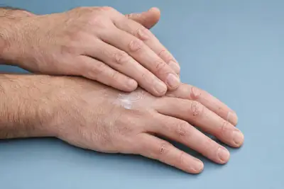 Applying Moisturizer to Dry Cracked Hands - Clinical Dermatology Photo