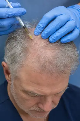 Senior Patient Receiving Hair Loss Treatment Therapy Injection - Medical Photo