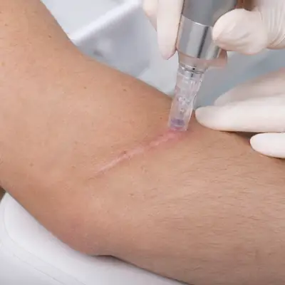 Microneedling Treatment on Surgical Scar on Arm - Clinical Dermatology Stock Photo