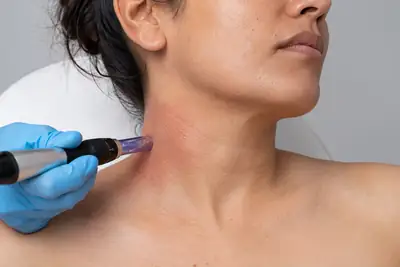 Dermatology Neck Microneedling Procedure for Skin Texture Treatment