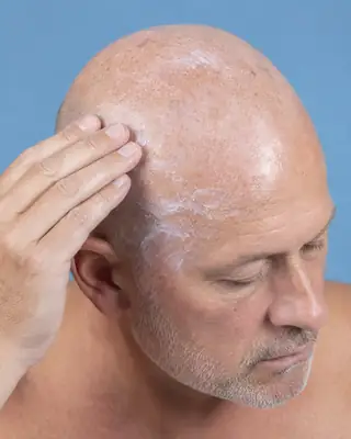 Patient Applying SPF Sunscreen Cream to Bald Scalp - Dermatology Photo