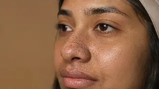 Close-Up of Nose Blackheads and Enlarged Pores on Young Woman - Dermatology Photo