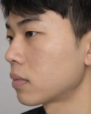 Open Comedones on Young Male Cheek - Dermatology Clinical Photo
