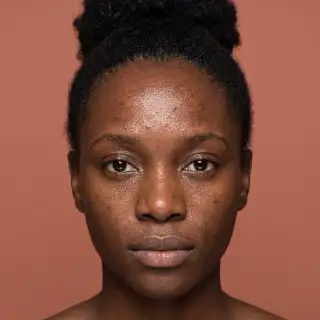 Black Woman with Facial Acne and Skin Texture - Dermatology Stock Photo
