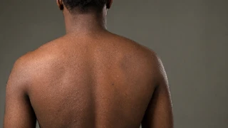 Dermatitis Rash on Patient Back - Clinical Dermatology Stock Photo