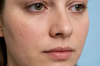 Close-Up of Face with Enlarged Pores and Milia on Nose - Dermatology Stock Photo