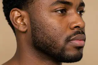 Close-up of Male Face Showing Acne Vulgaris and Papules - Dermatology Photo