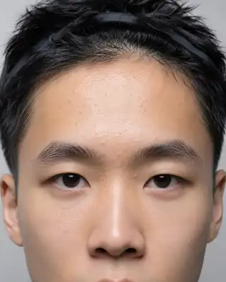 Mild Acne and Comedones on Young Male Forehead - Dermatology Stock Photo
