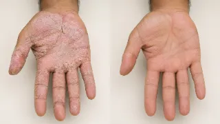 Palmar Psoriasis Before and After Treatment - Clinical Dermatology Photo