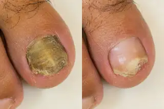 Before and After Treatment of Toenail Fungus Onychomycosis Stock Photo