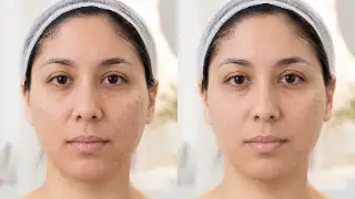Before and After Treatment of Facial Acne Scars and Hyperpigmentation